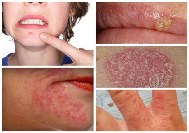 Alerģijas un ādas slimības ir parazītu pazīmes organismā