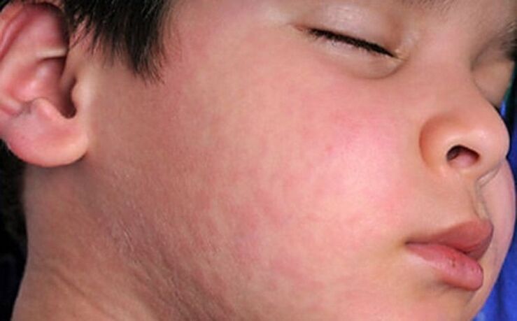 Alerģiski izsitumi uz ādas - simptoms parazītu tārpu klātbūtnei organismā